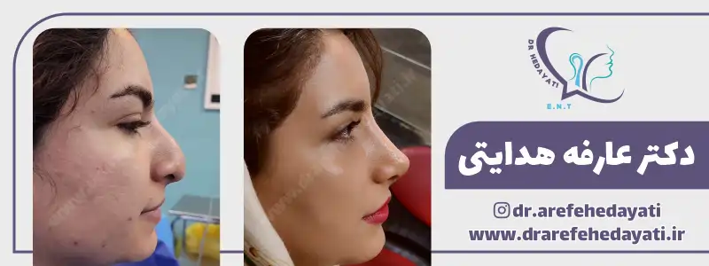 نمونه کار بهترین جراح بینی کرمانشاه